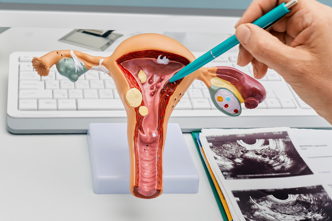 Uterine Polyps on an anatomical model