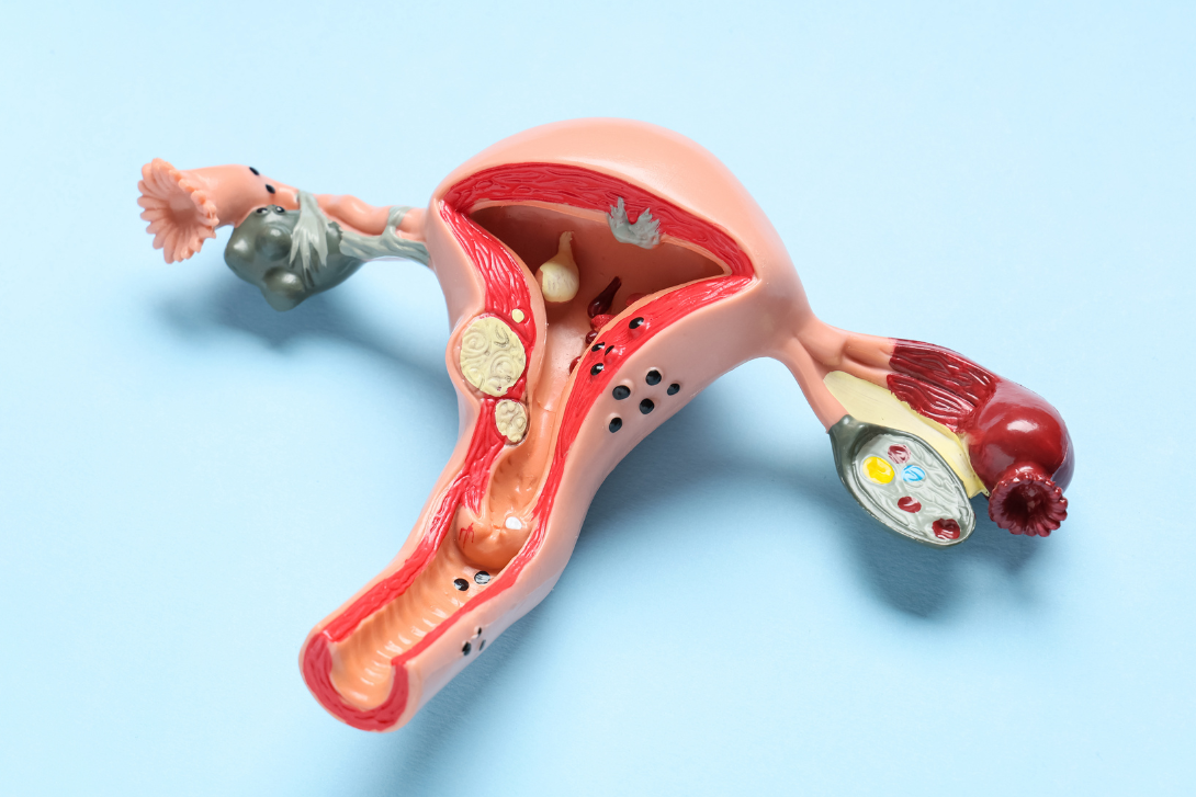 Uterine Fibroids: Symptoms, Types & Treatment